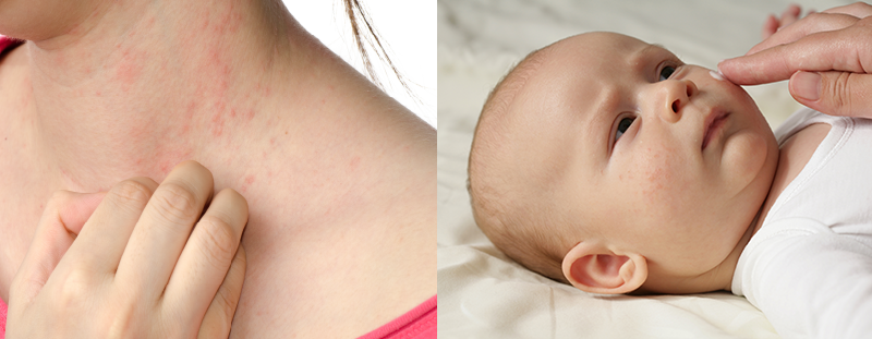 eczema for email neck and baby